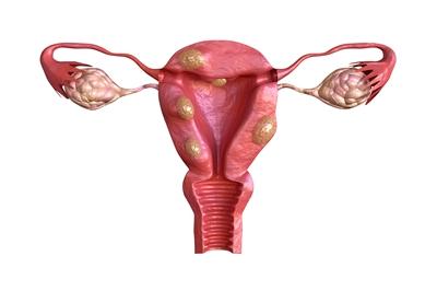 Uterine fibroids bleed anal sex