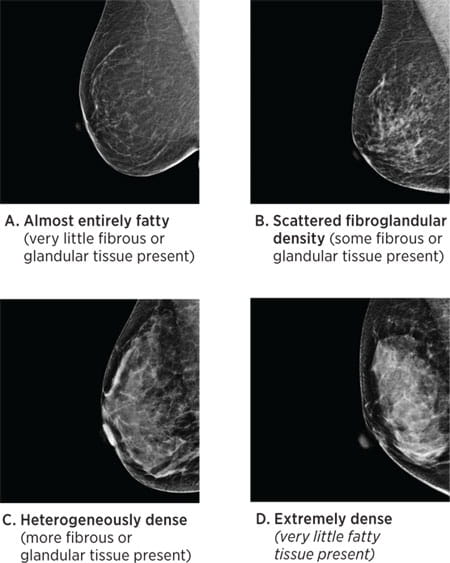 Breast Density: What It Is And What It Means To You | Breast Cancer ...